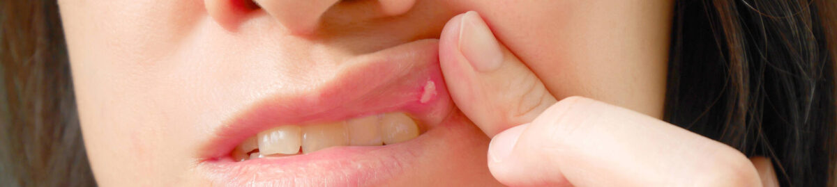 Dentist Berwyn, IL | Ow! Your Guide to Canker Sores