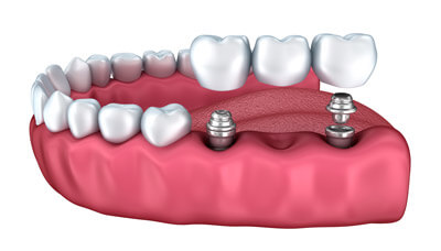 Dental Implant Bridge Image