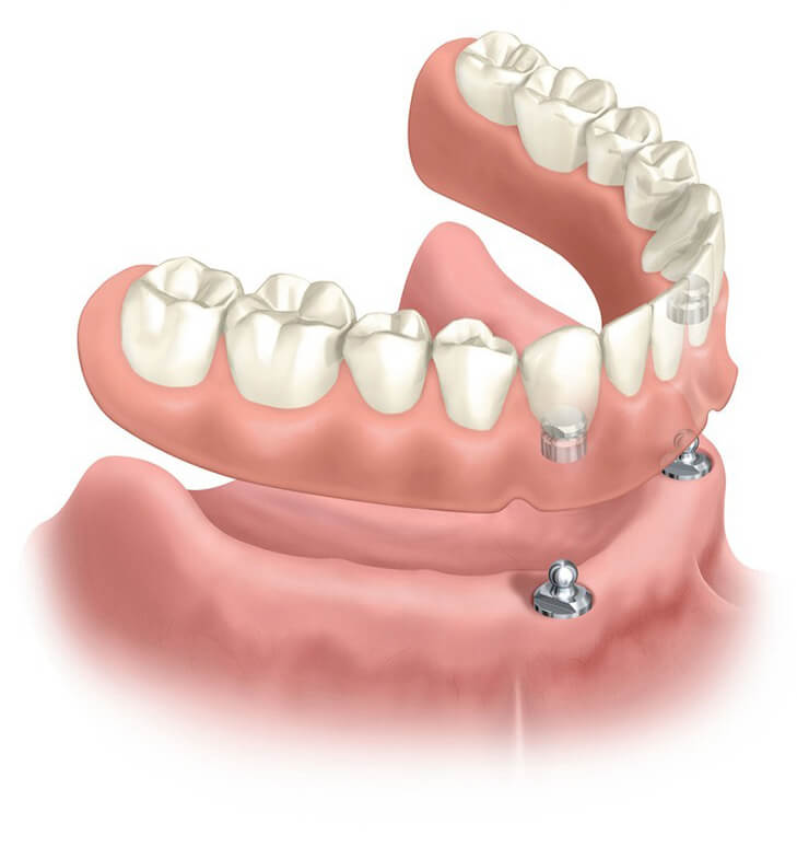 Implant Dentures Image