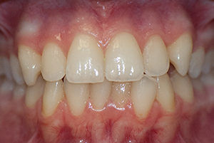 Berwyn-Dentist-Before-3-300x201