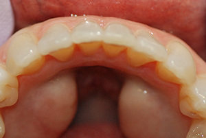 Dentist-Berwyn-After-3-300x201