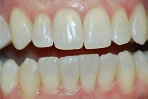 Dentist-Berwyn-After-4-300x201
