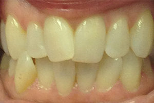 Dentist-Berwyn-Before-1-300x201