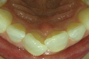 Dentist-Berwyn-Before-3-e1466196036427-300x201