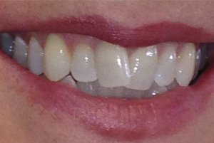 Dentist-Berywn-Before-4