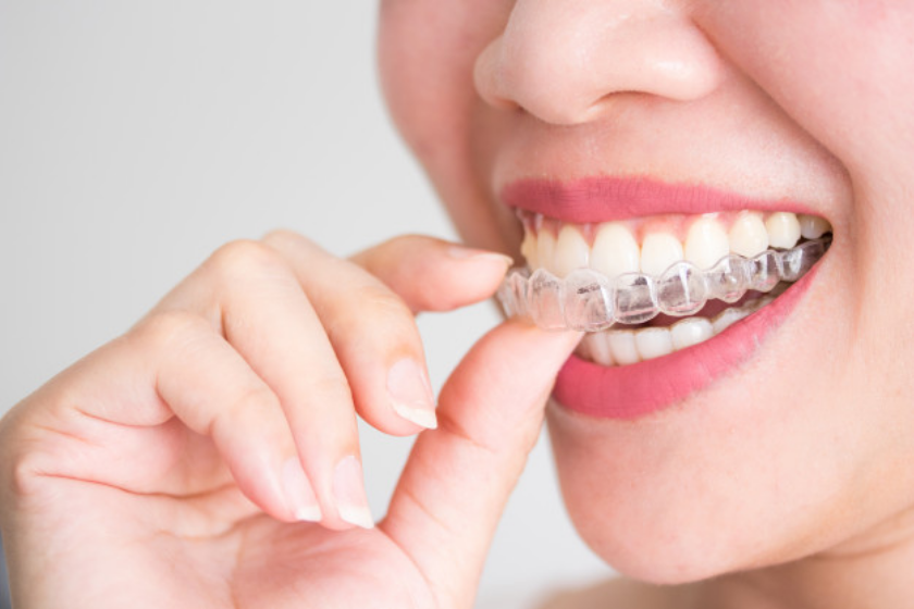 4 Reasons Why Invisalign Treatment Option is The Best in Orthodontics