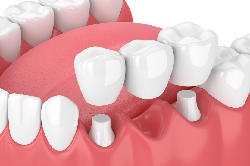 When Should You Get Dental Bridges for Missing Teeth?