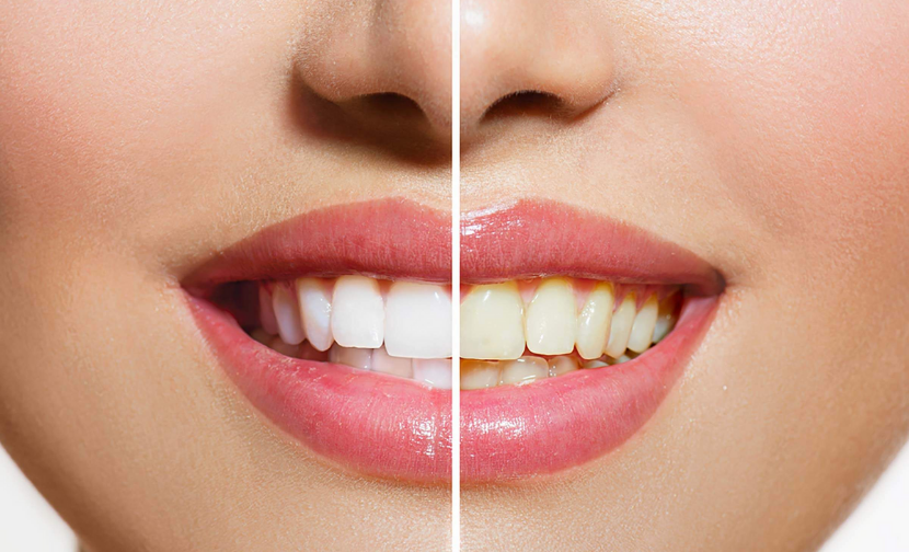How To Get A Dazzling Smile With Teeth Whitening
