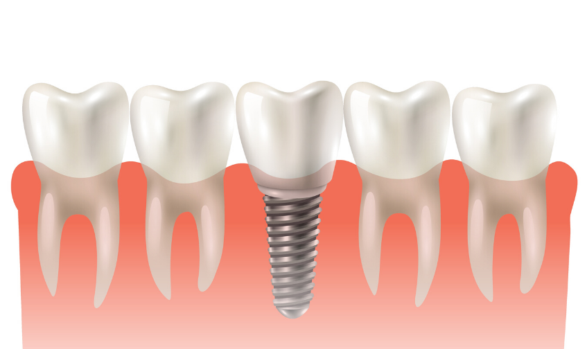 Why Should Seniors Opt For Dental Implants?