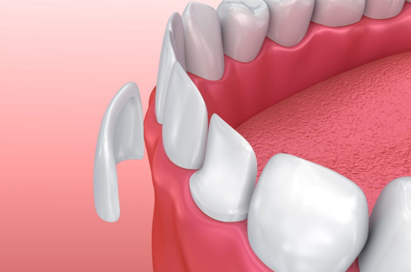 Restore Your Beautiful Smile with Dental Veneers