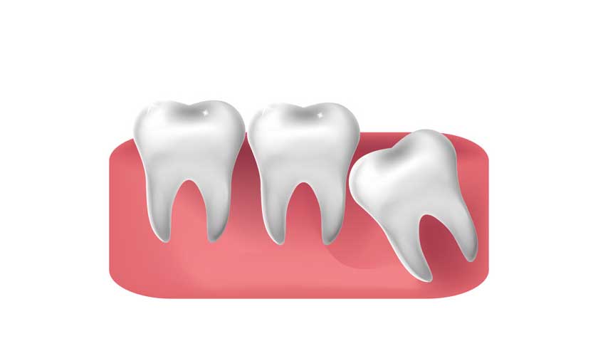 Cost of Wisdom Teeth Removal