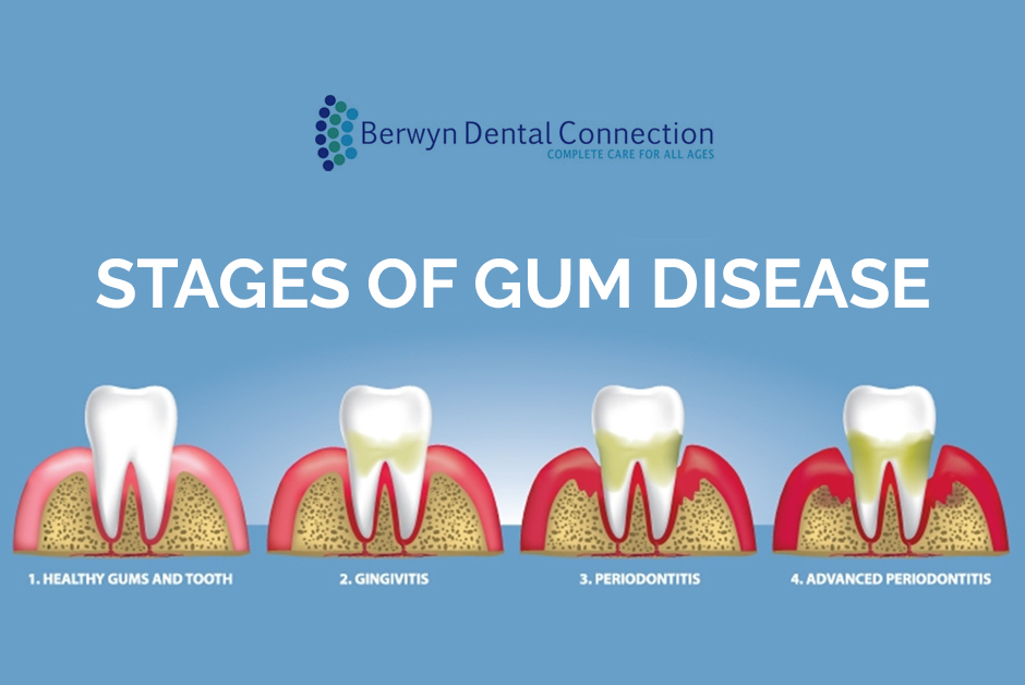 receding gums stages