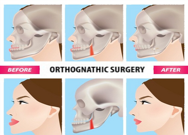 What Are The Different Kinds of Orthognathic Surgeries?