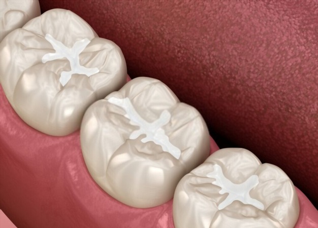 Sealants for Dental Care
