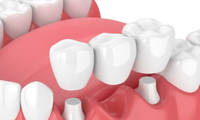 Which is a better option for you: a dental crown or a dental bridge?