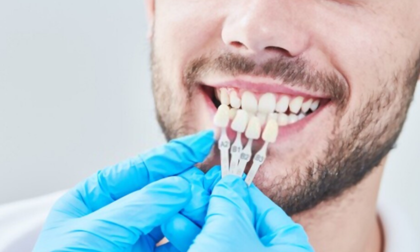 What are dental veneers and what are their advantages?
