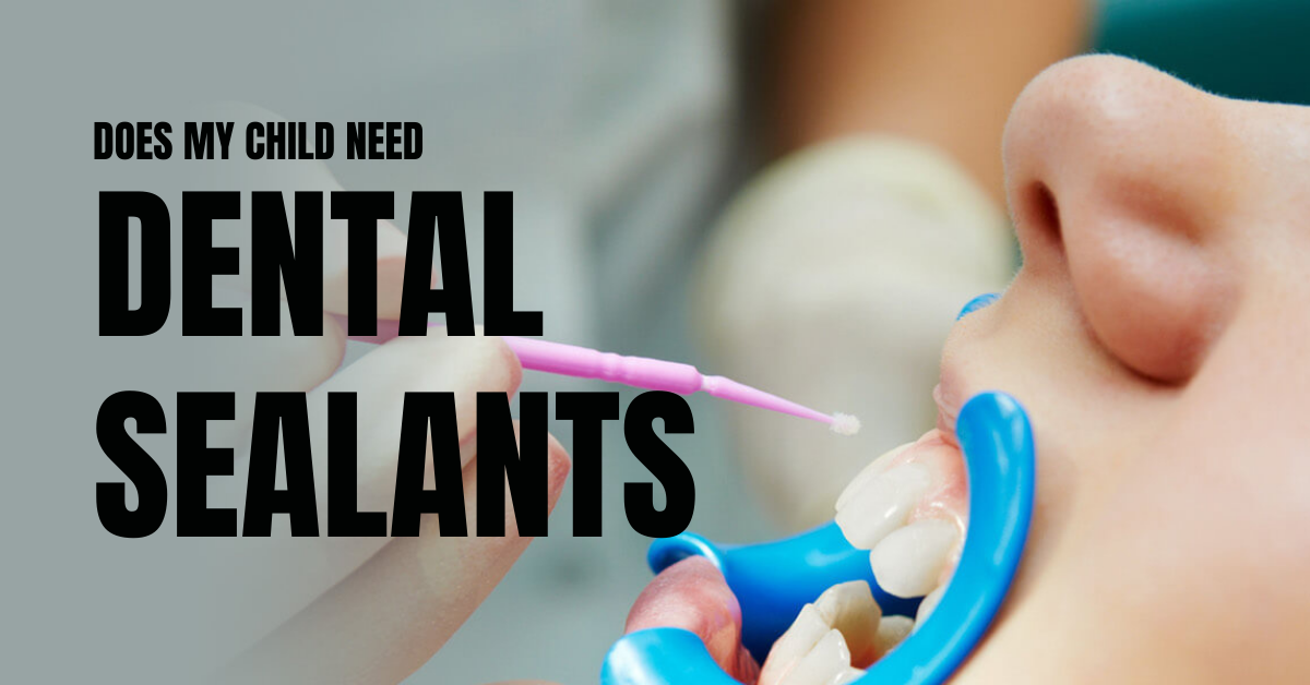 Does My Child Need Dental Sealants?
