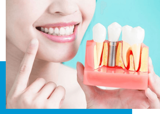 4 Common Questions Related To Dental Implants