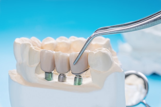 Dentures VS Implants: Which One Is Better For You?