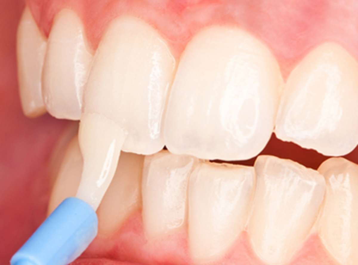 Fluoride Treatment: A Safe And Effective Solution For Tooth Sensitivity