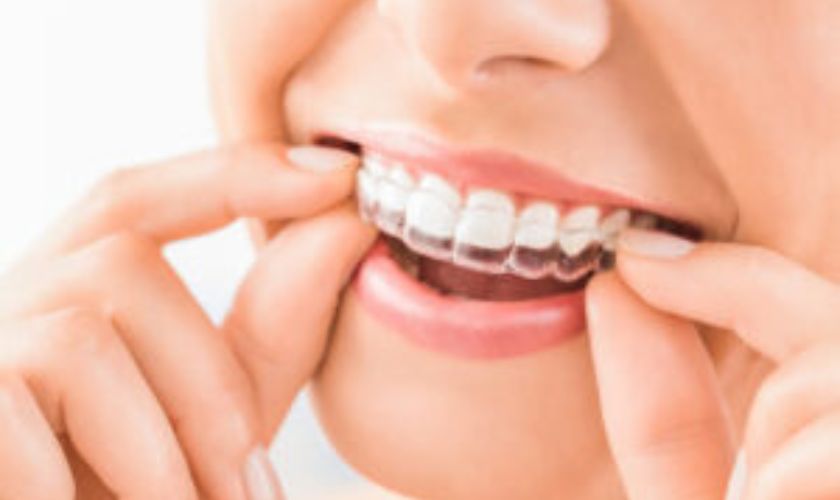 How To Maintain Proper Oral Hygiene With Invisalign Aligners