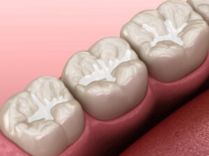 The Science Behind Composite Fillings: How They Work