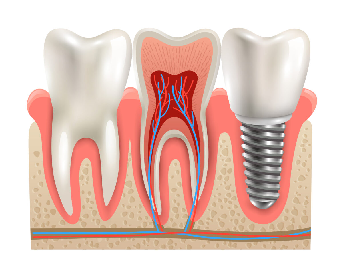 How Does Root Canal Treatment Help You?