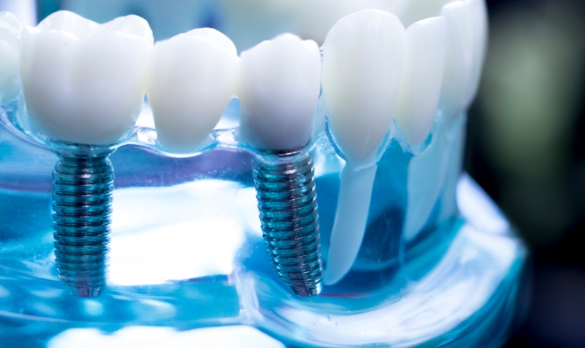dental implants in berwyn, il