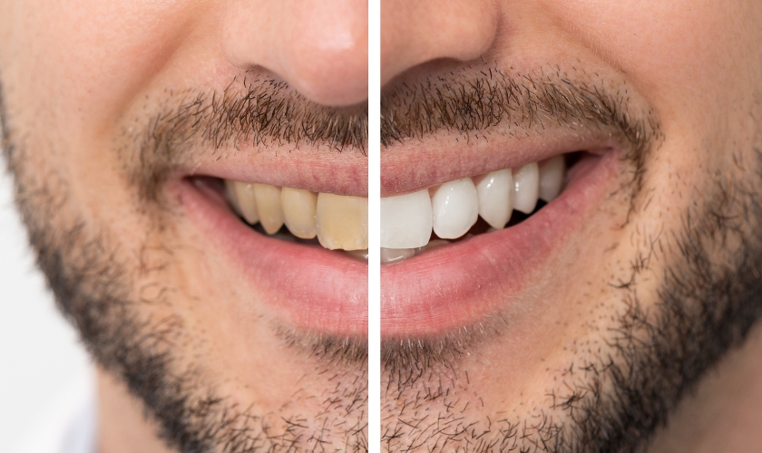Teeth Whitening for Sensitive Teeth: What Are Your Options?