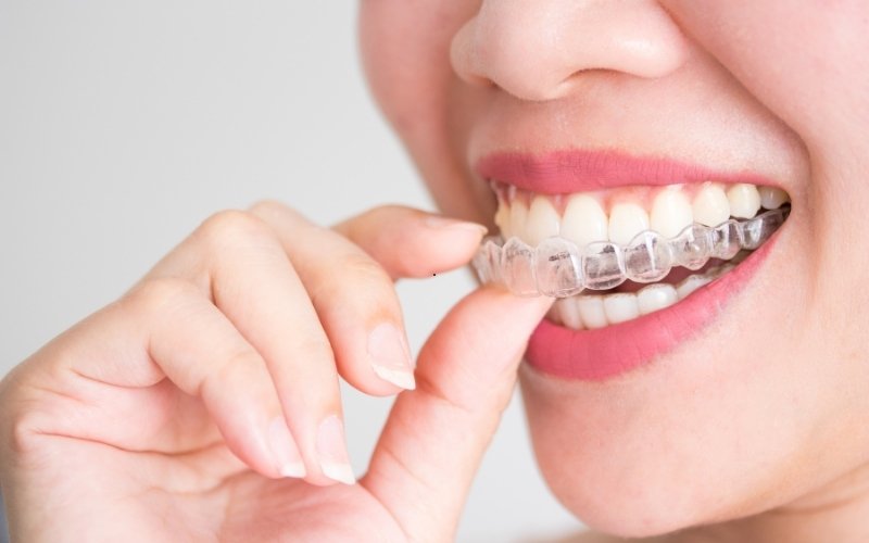 key factors to consider while getting invisalign