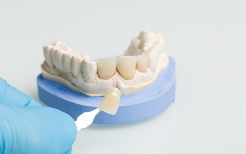 tips to care for dental veneers to ensure longevity