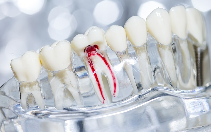 best foods to eat after root canal treatment
