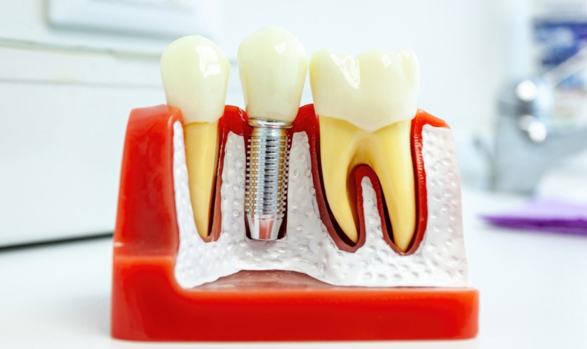 dental implants in Berwyn